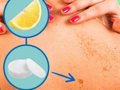 10 ways to remove dark spots at home