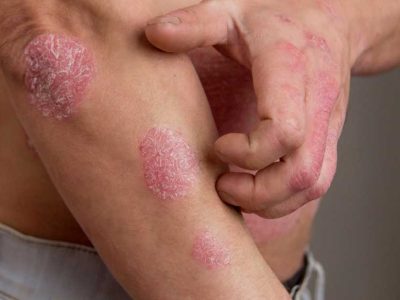 A Doctor-Approved Guide to Eczema Itch Relief
