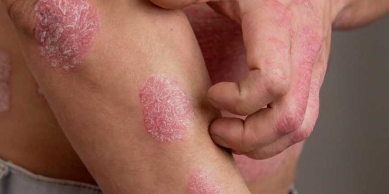 A Doctor-Approved Guide to Eczema Itch Relief