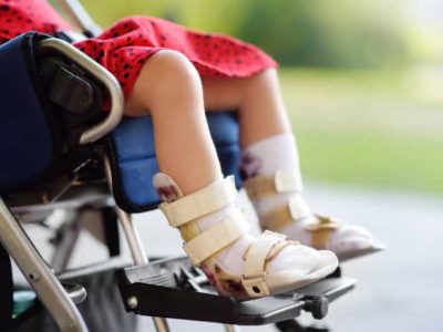 Erb’s Palsy: Overview, Symptoms, Treatment, & Therapy 2 Erb’s Palsy