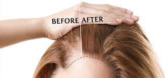 Know The Stages Of Hair Transplantation In Istanbul